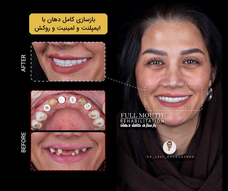 بازسازی کامل دهان با ایمپلنت لمینیت و روکش